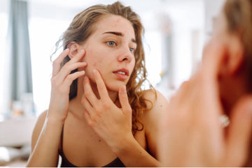 What Your Acne Is Telling You: A Gut-First Guide to Understanding Your Skin